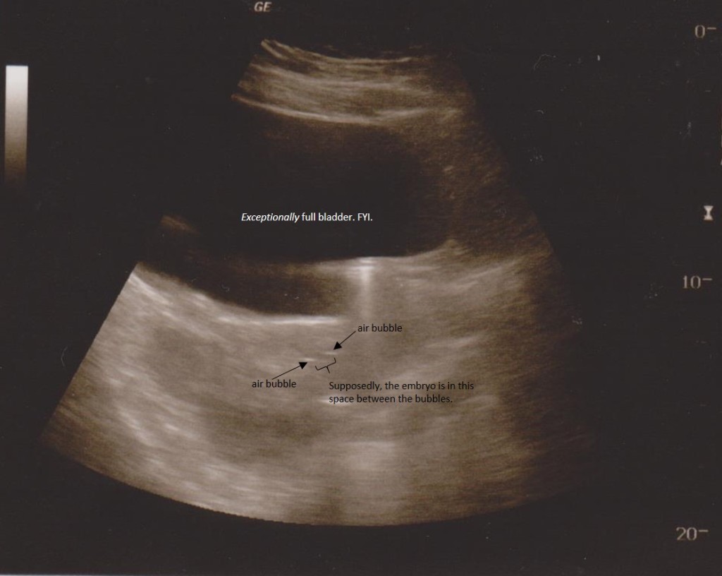 embryo ultrasound labeled